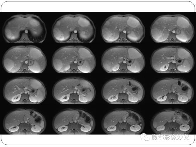 【病例】糖原累积症肝型伴肝腺瘤1例CT 【病例】糖原累积症肝型伴肝腺瘤1例CT