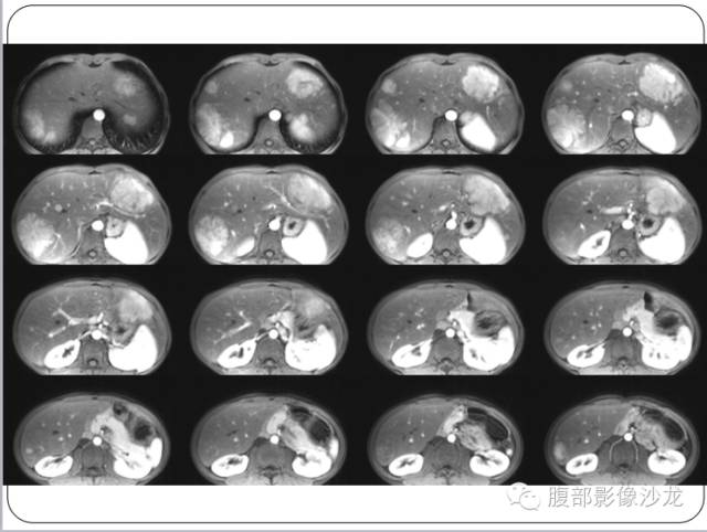 【病例】糖原累积症肝型伴肝腺瘤1例CT 【病例】糖原累积症肝型伴肝腺瘤1例CT