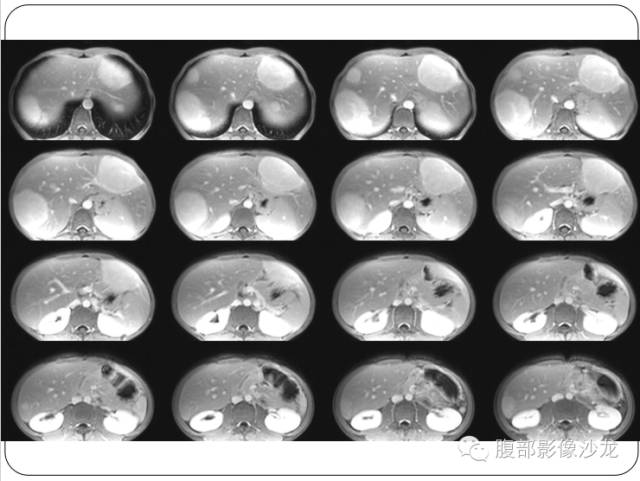 【病例】糖原累积症肝型伴肝腺瘤1例CT 【病例】糖原累积症肝型伴肝腺瘤1例CT