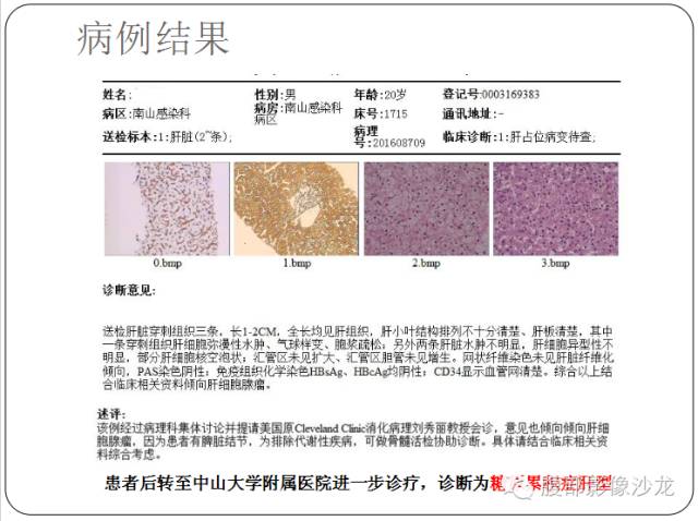 【病例】糖原累积症肝型伴肝腺瘤1例CT 【病例】糖原累积症肝型伴肝腺瘤1例CT