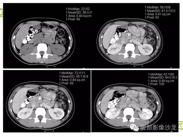 【病例】胰腺神经内分泌瘤1例CT影像表现