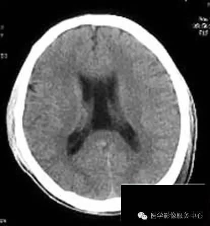 我们常说的第五脑室就真的错了吗？