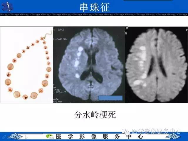 【影像征象】串珠征——分水岭脑梗死