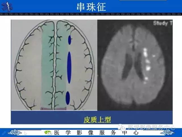 【影像征象】串珠征——分水岭脑梗死