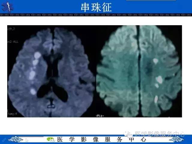 【影像征象】串珠征——分水岭脑梗死
