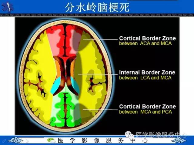 【影像征象】串珠征——分水岭脑梗死