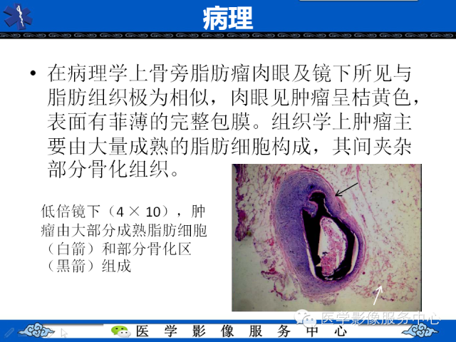 【PPT】骨旁脂肪瘤的影像学表现