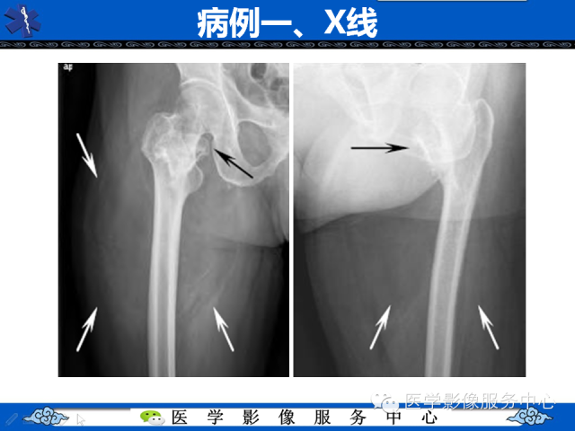 【PPT】骨旁脂肪瘤的影像学表现