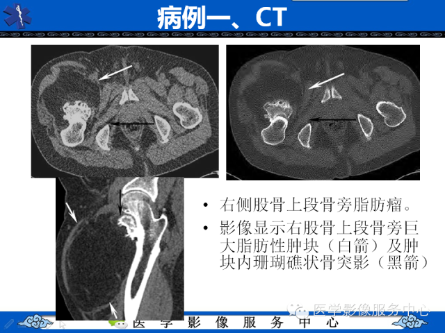 【PPT】骨旁脂肪瘤的影像学表现