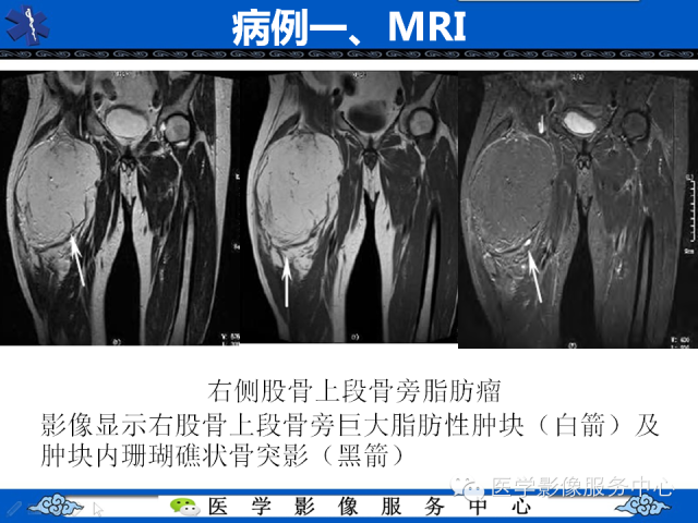 【PPT】骨旁脂肪瘤的影像学表现