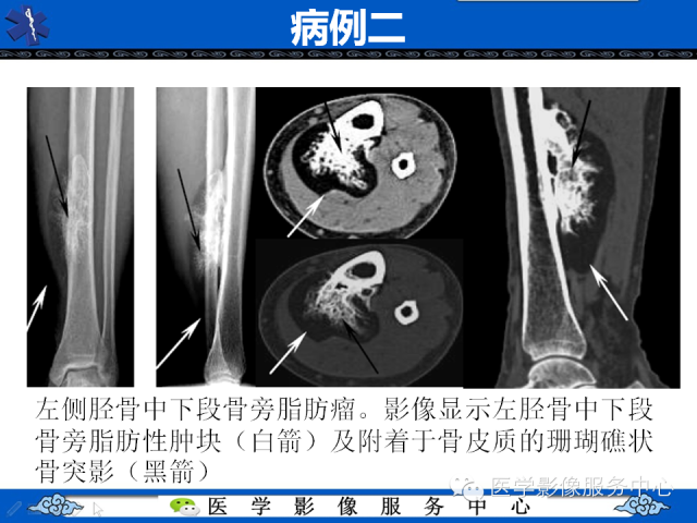 【PPT】骨旁脂肪瘤的影像学表现