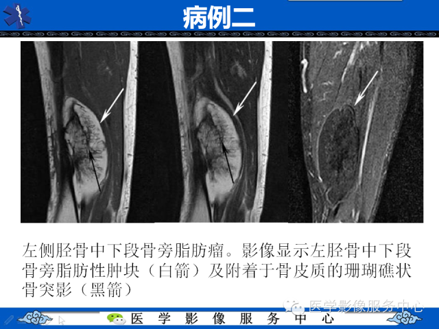 【PPT】骨旁脂肪瘤的影像学表现