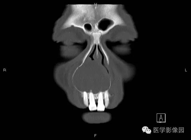 【病例】上颌骨含牙囊肿1例CT影像表现