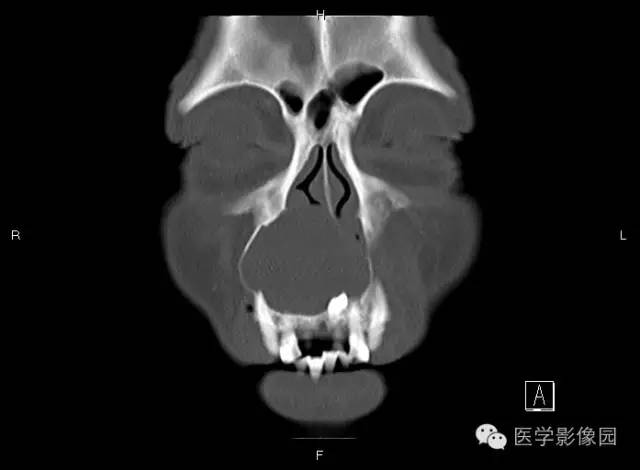 【病例】上颌骨含牙囊肿1例CT影像表现