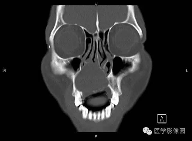 【病例】上颌骨含牙囊肿1例CT影像表现