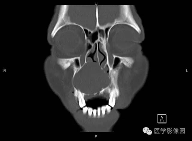 【病例】上颌骨含牙囊肿1例CT影像表现