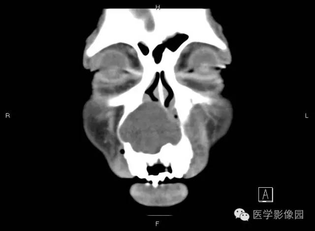 【病例】上颌骨含牙囊肿1例CT影像表现