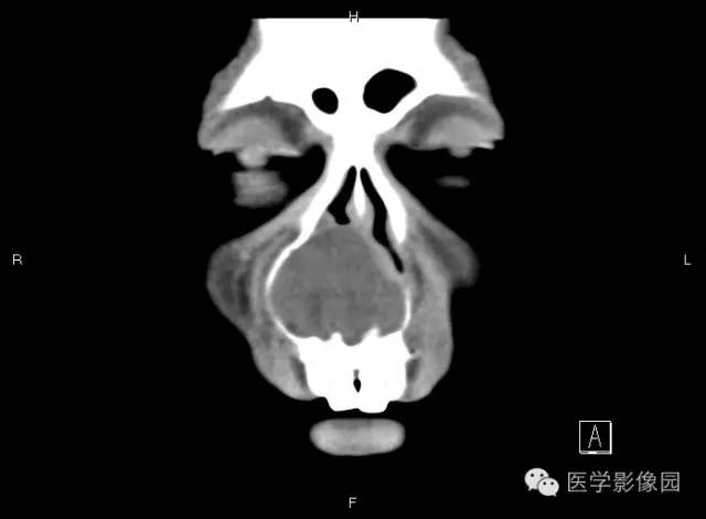 【病例】上颌骨含牙囊肿1例CT影像表现