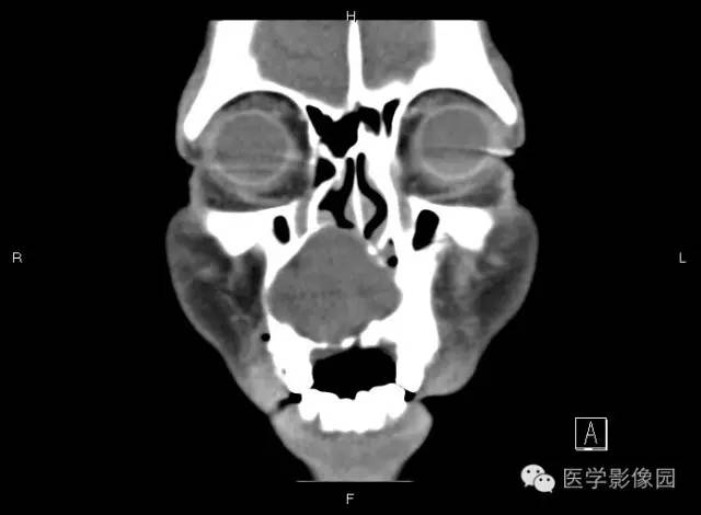 【病例】上颌骨含牙囊肿1例CT影像表现