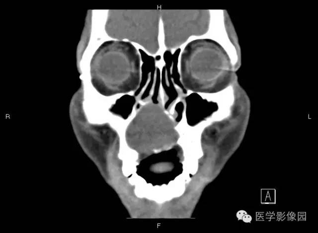 【病例】上颌骨含牙囊肿1例CT影像表现