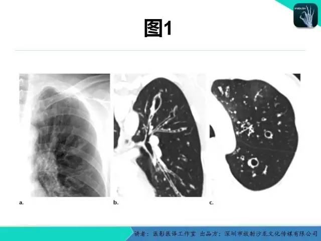 【PPT】支气管扩张：相关常见及不常见疾病的机制及影像特征