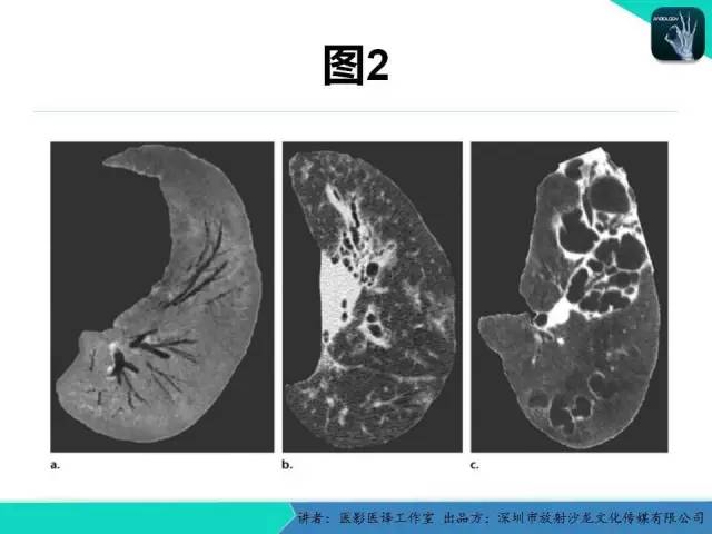 【PPT】支气管扩张：相关常见及不常见疾病的机制及影像特征