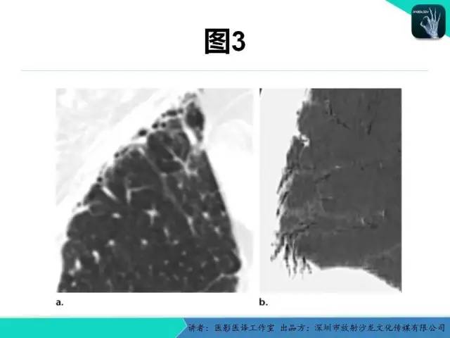 【PPT】支气管扩张：相关常见及不常见疾病的机制及影像特征