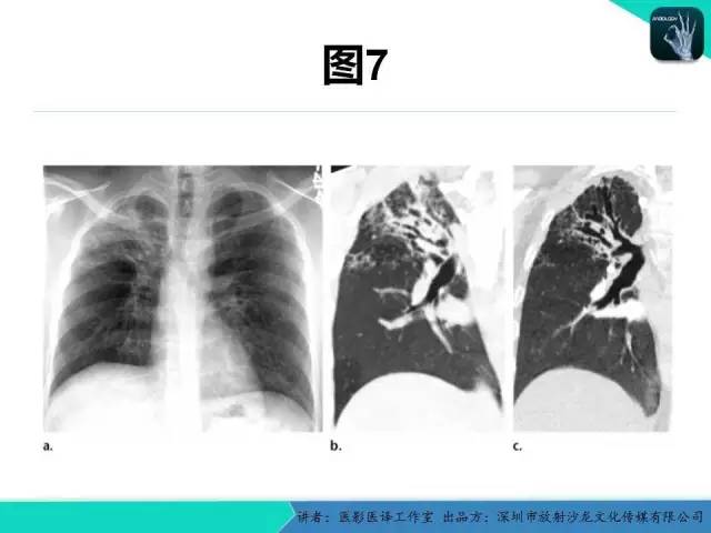 【PPT】支气管扩张：相关常见及不常见疾病的机制及影像特征