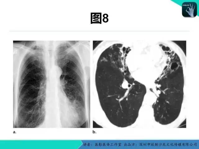 【PPT】支气管扩张：相关常见及不常见疾病的机制及影像特征