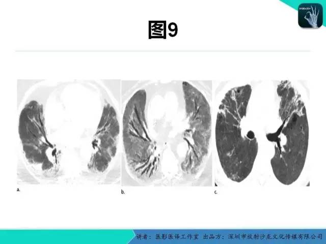 【PPT】支气管扩张：相关常见及不常见疾病的机制及影像特征