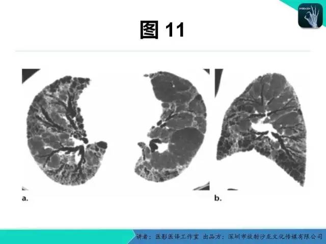 【PPT】支气管扩张：相关常见及不常见疾病的机制及影像特征