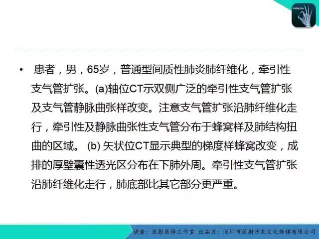 【PPT】支气管扩张：相关常见及不常见疾病的机制及影像特征