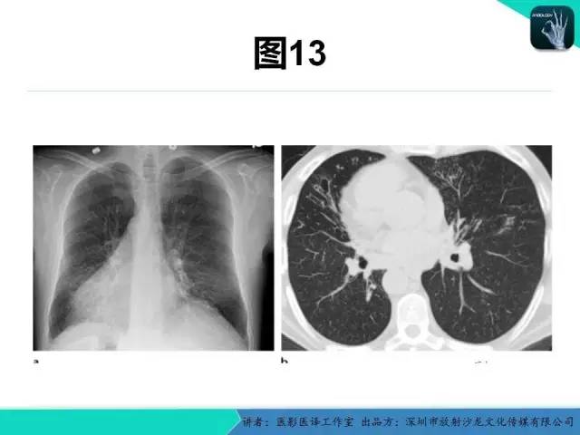 【PPT】支气管扩张：相关常见及不常见疾病的机制及影像特征