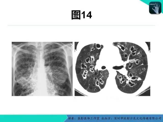 【PPT】支气管扩张：相关常见及不常见疾病的机制及影像特征