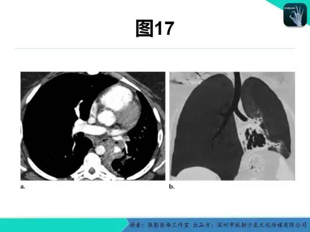 【PPT】支气管扩张：相关常见及不常见疾病的机制及影像特征
