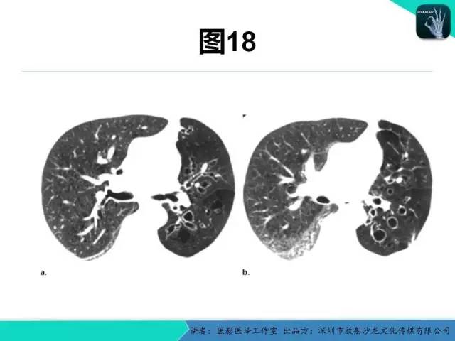 【PPT】支气管扩张：相关常见及不常见疾病的机制及影像特征