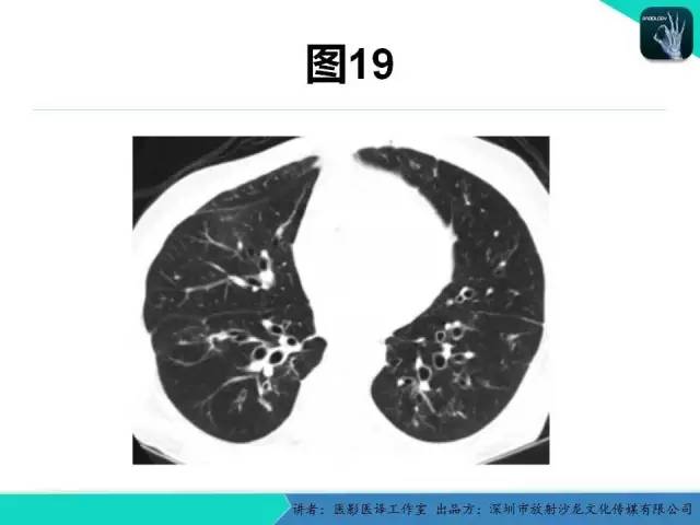 【PPT】支气管扩张：相关常见及不常见疾病的机制及影像特征