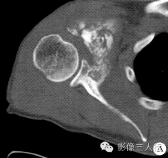 【病例】右肩胛骨骨软骨瘤恶变1例X线及CT影像表现