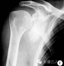 【病例】右肩胛骨骨软骨瘤恶变1例X线及CT影像表现 【病例】右肩胛骨骨软骨瘤恶变1例X线及CT影像表现