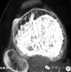【病例】右胫骨骨血管瘤1例影像表现 【病例】右胫骨骨血管瘤1例影像表现