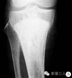 【病例】右胫骨骨血管瘤1例影像表现