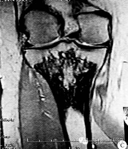 【病例】右胫骨骨血管瘤1例影像表现 【病例】右胫骨骨血管瘤1例影像表现