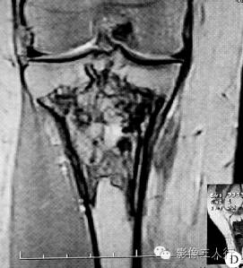 【病例】右胫骨骨血管瘤1例影像表现 【病例】右胫骨骨血管瘤1例影像表现