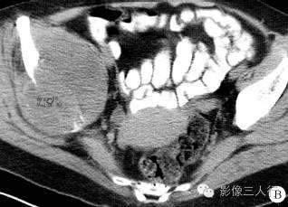 【病例】右侧髂骨黏液纤维肉瘤1例CT影像表现 【病例】右侧髂骨黏液纤维肉瘤1例CT影像表现