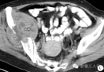 【病例】右侧髂骨黏液纤维肉瘤1例CT影像表现 【病例】右侧髂骨黏液纤维肉瘤1例CT影像表现