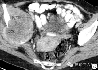 【病例】右侧髂骨黏液纤维肉瘤1例CT影像表现 【病例】右侧髂骨黏液纤维肉瘤1例CT影像表现