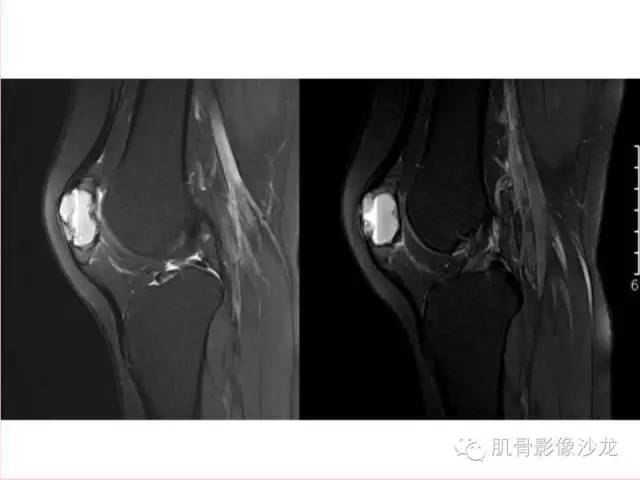 【病例】软骨母细胞瘤合并ABC一例X线及MR影像表现