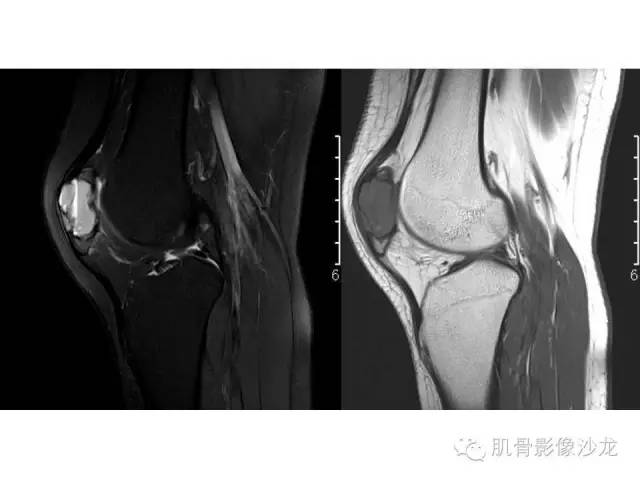 【病例】软骨母细胞瘤合并ABC一例X线及MR影像表现
