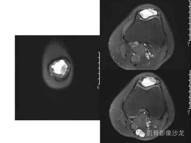 【病例】软骨母细胞瘤合并ABC一例X线及MR影像表现