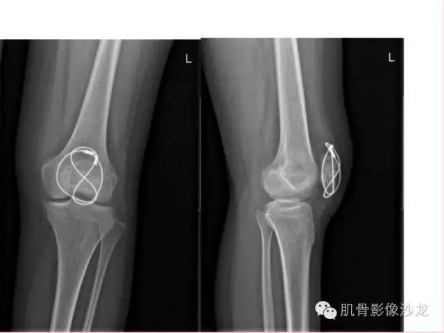【病例】软骨母细胞瘤合并ABC一例X线及MR影像表现
